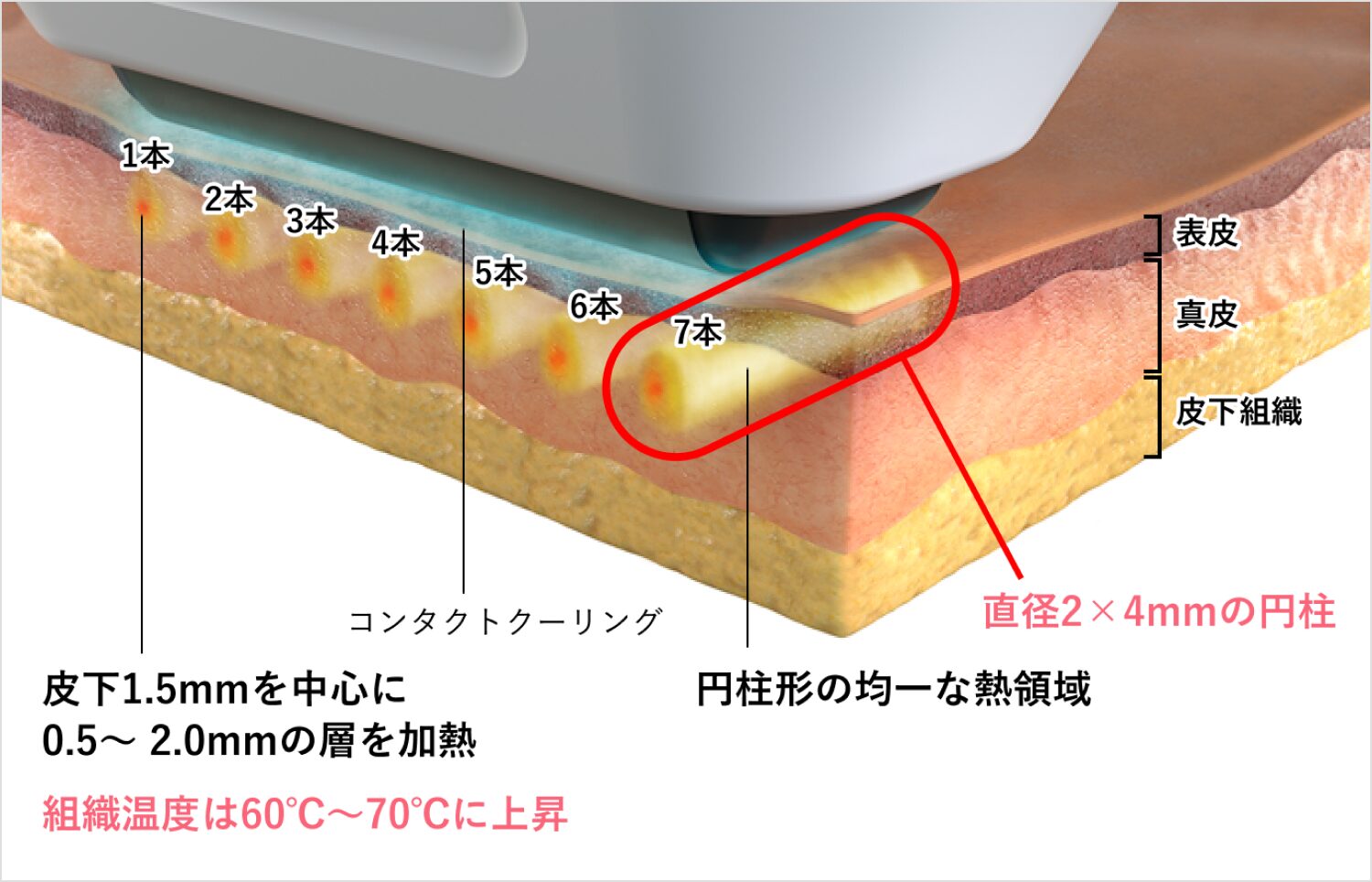 実際の照射イメージ