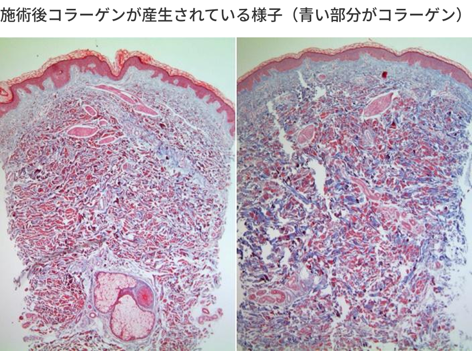 施術後コラーゲンが産生されている様子(青い部分がコラーゲン)