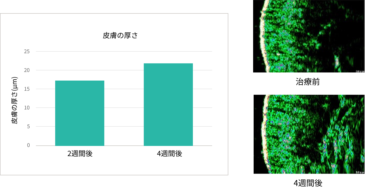 真皮・表皮の厚さ