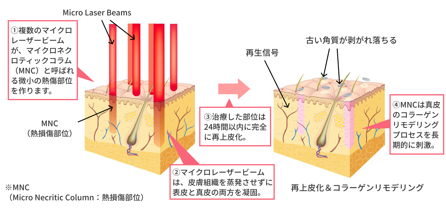 モザイク3Dによる肌断面図の変化
