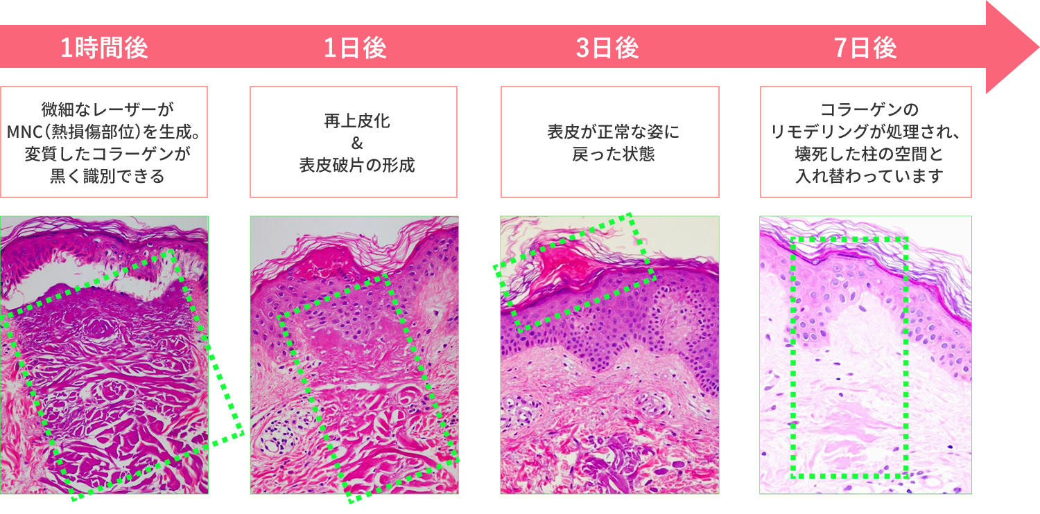 モザイク3Dによる肌断面図の変化の写真